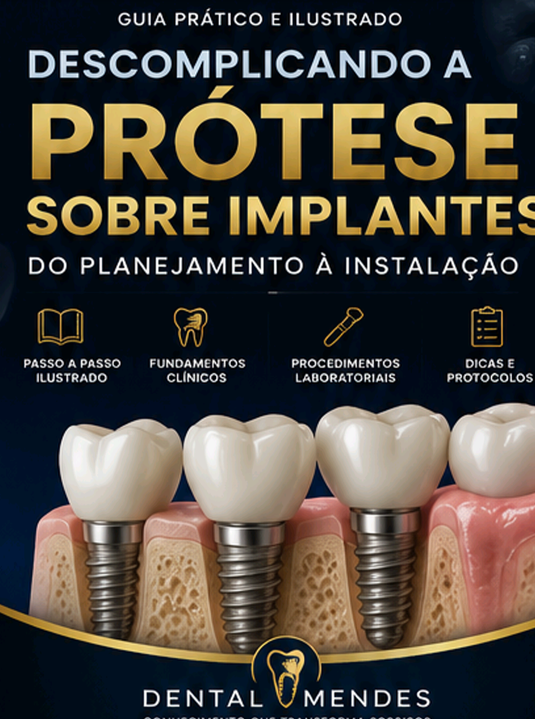 Capa do ebook Descomplicando a Prótese sobre Implantes